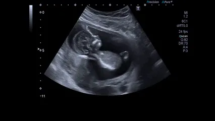 Horizontal video: Ultrasound of a baby 3099938. Duration: 31 seconds. Resolution: 1920x1080