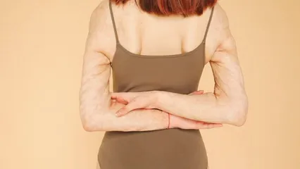 Horizontal video: Woman with skin burns 4519308. Duration: 3 seconds. Resolution: 1920x1080