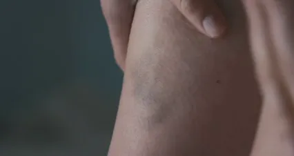 Horizontal video: A person leg with a bruise 8191101. Duration: 8 seconds. Resolution: 4096x2160